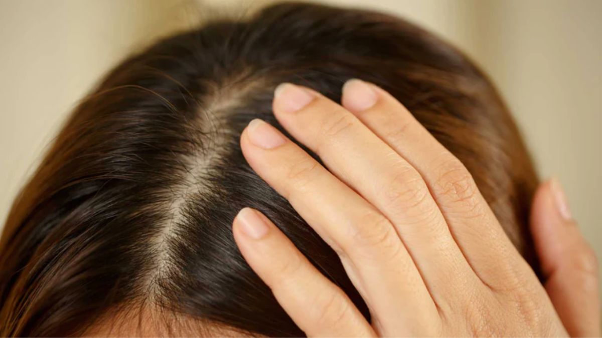 How To Remove Dandruff? Effective Dandruff Solutions For Clean Scalp This Winter Season