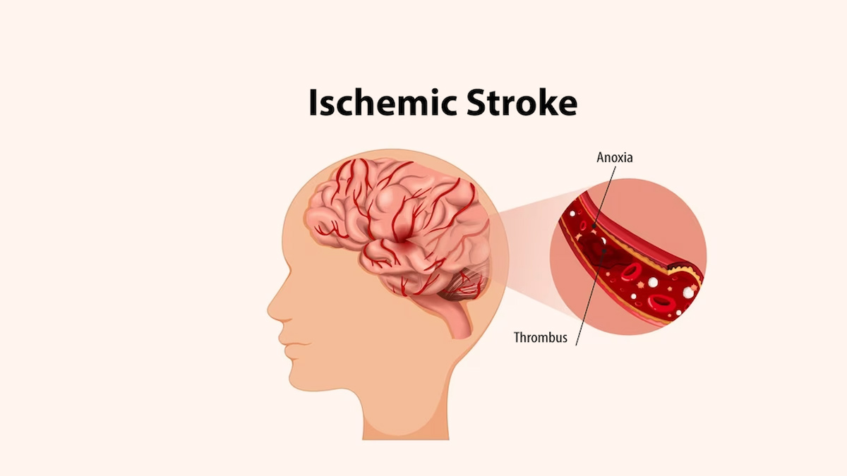 everything about ischemic